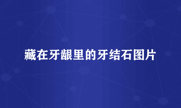 藏在牙龈里的牙结石图片