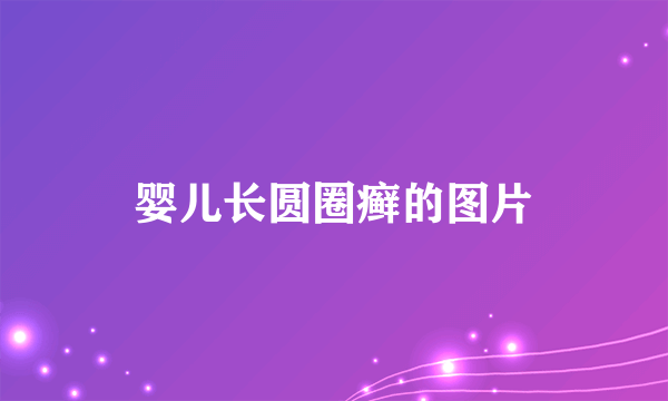 婴儿长圆圈癣的图片