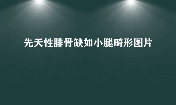 先天性腓骨缺如小腿畸形图片